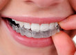 Invisalign clear trays - The clear and better solution for adults